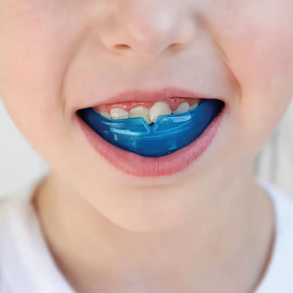 Niềng răng bằng phương pháp dùng hàm trainer ở trẻ