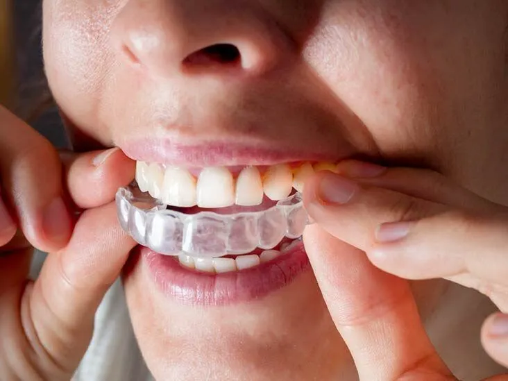 Niềng răng Invisalign là phương pháp niềng răng hiện đại 