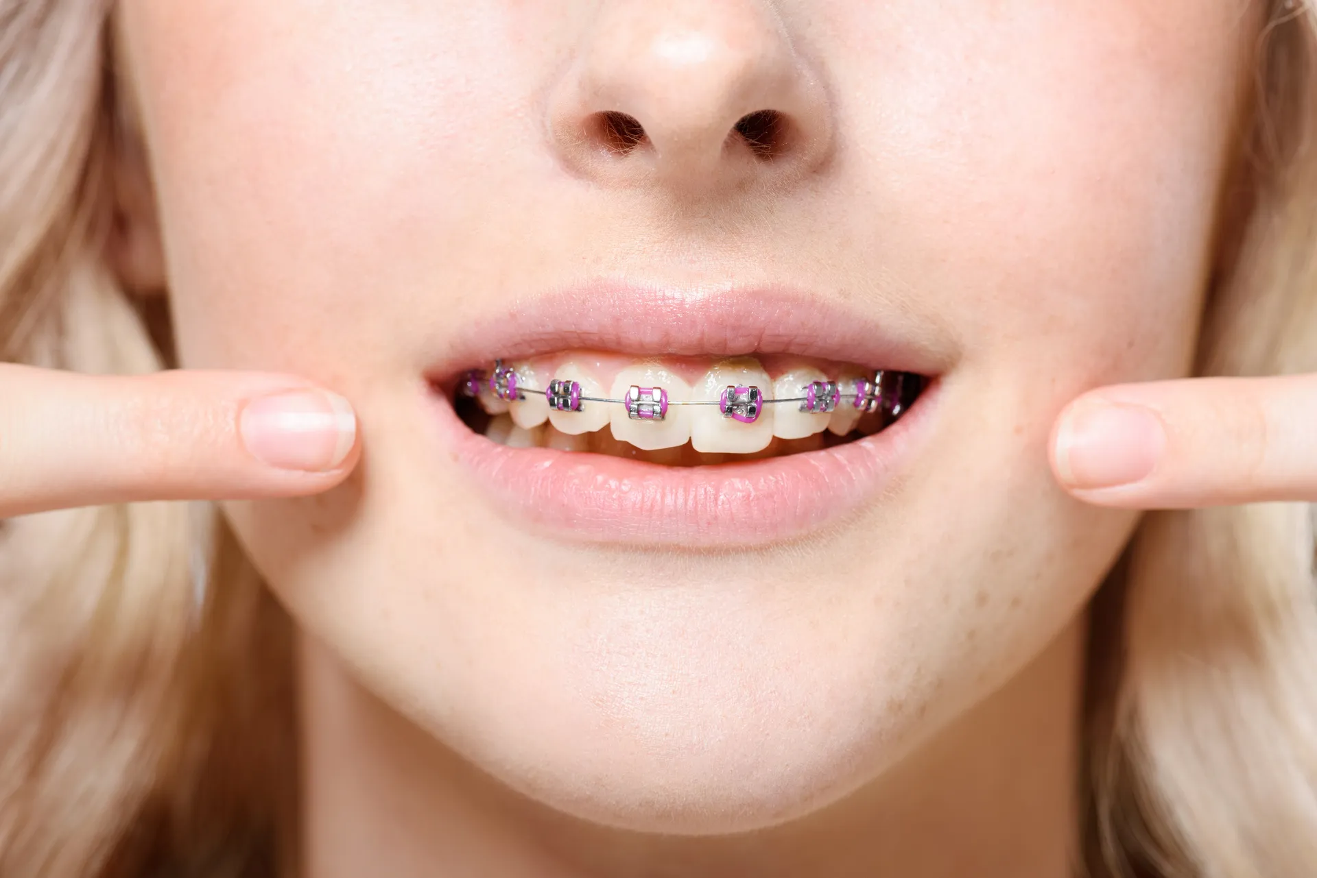 Niềng răng mắc cài kim loại là sự lựa chọn tiết kiệm chi phí nhất khi niềng răng hô