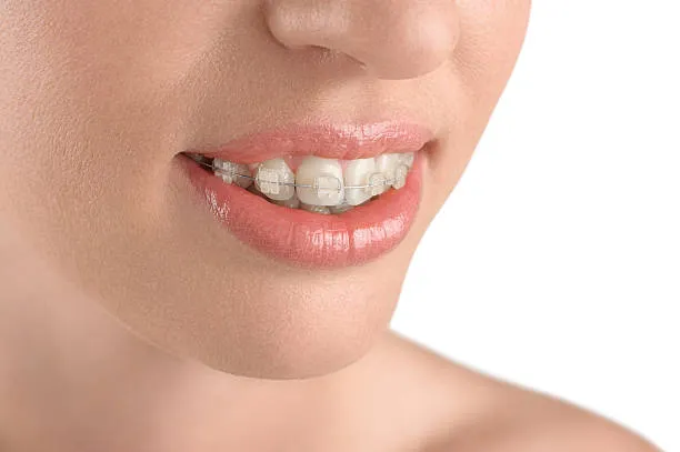 Với chất liệu sứ, niềng răng mắc cài sứ là sự lựa chọn có tính thẩm mỹ hơn khi niềng răng hô so với mắc cài kim loại thông thường