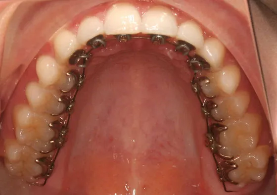 Niềng răng mắc cài mặt trong giúp giấu đi cái mắc cài nhưng vẫn đảm bảo hiệu quả trong quá trình niềng răng hô