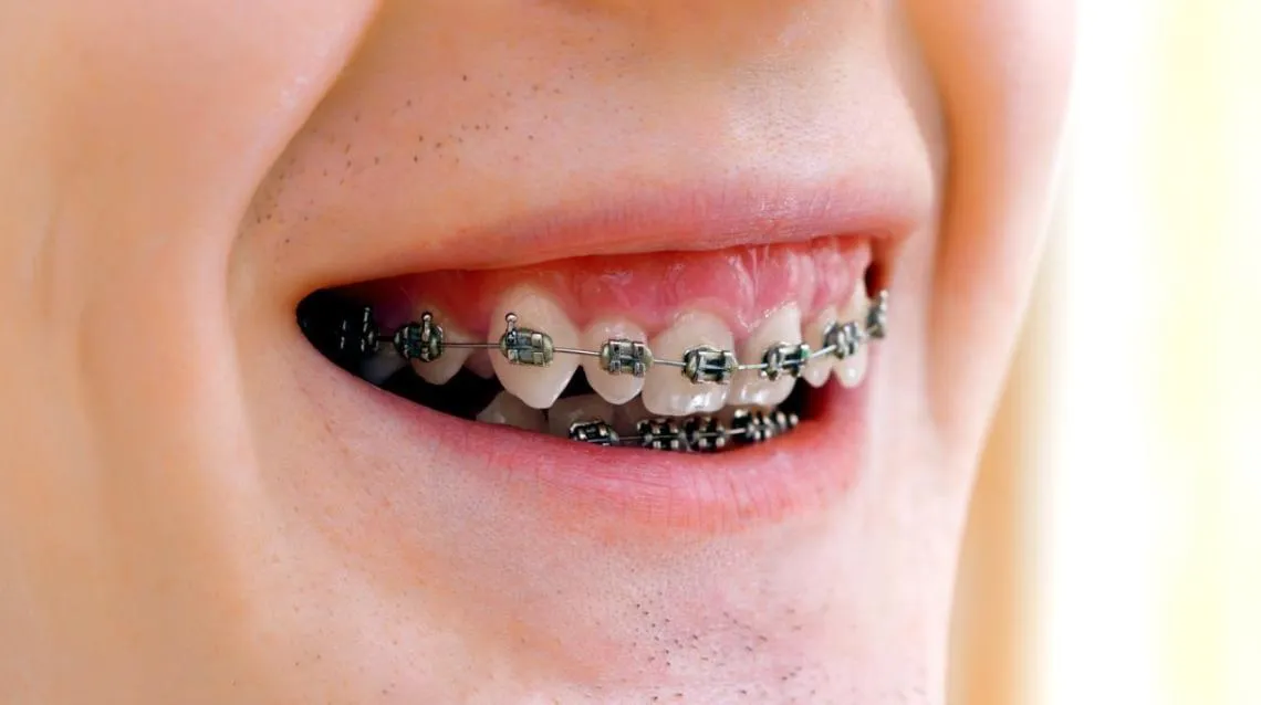 Niềng răng mắc cài sử dụng hệ thống mắc cài được gắn cố định lên răng