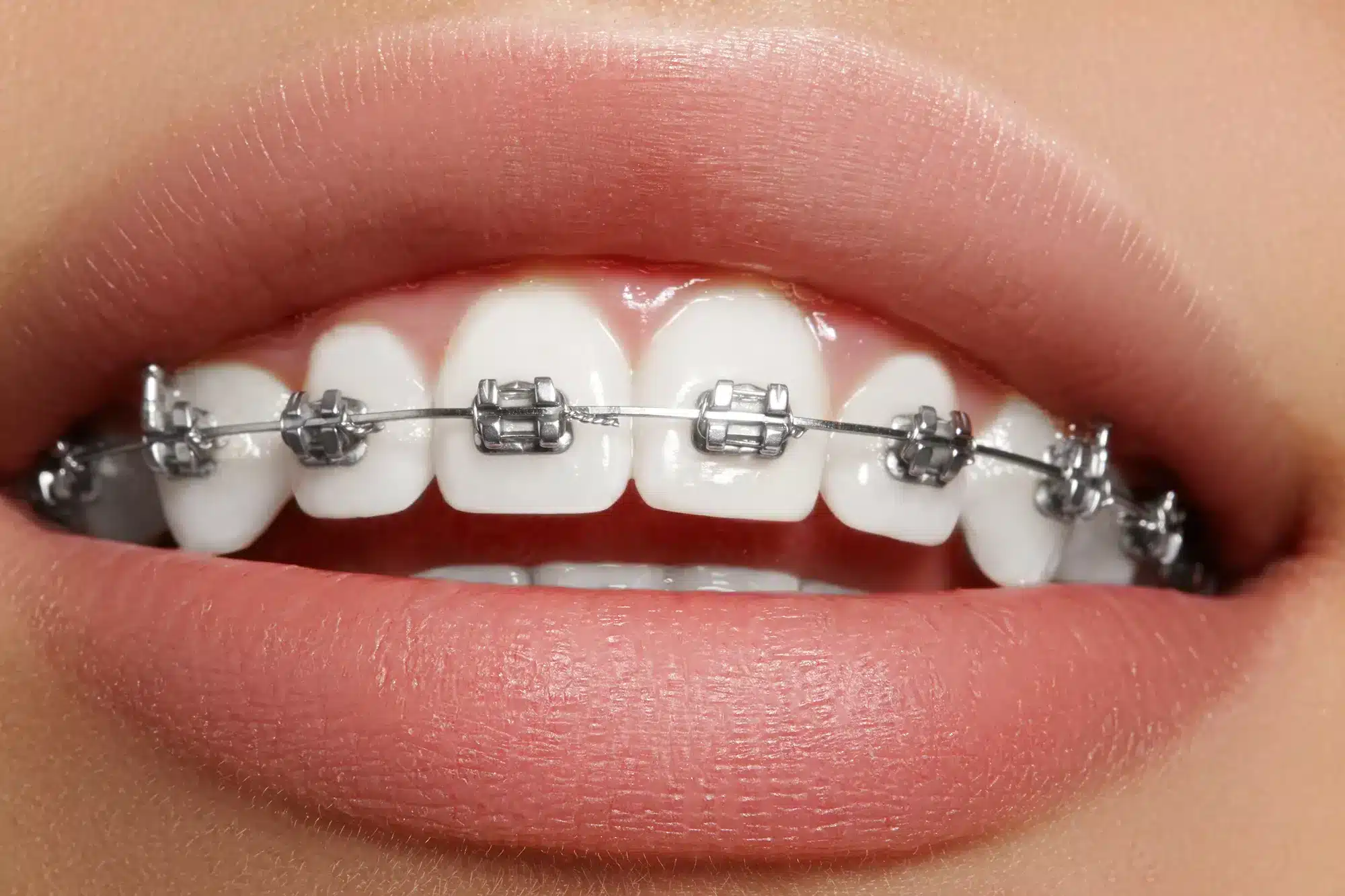 Niềng răng mắc cài kim loại đã có từ rất lâu đời nhưng vẫn phổ biến đến tận ngày nay
