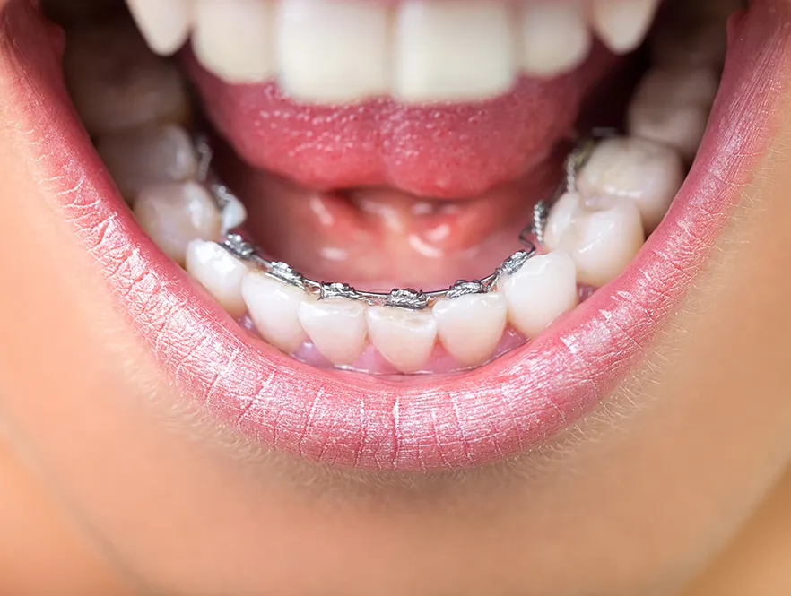 Niềng răng mắc cài kim loại mặt trong (mặt lưỡi)