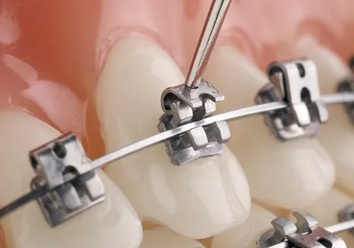 Niềng răng mắc cài tự đóng không cần sử dụng đến dây thun để giữa phần dây cung