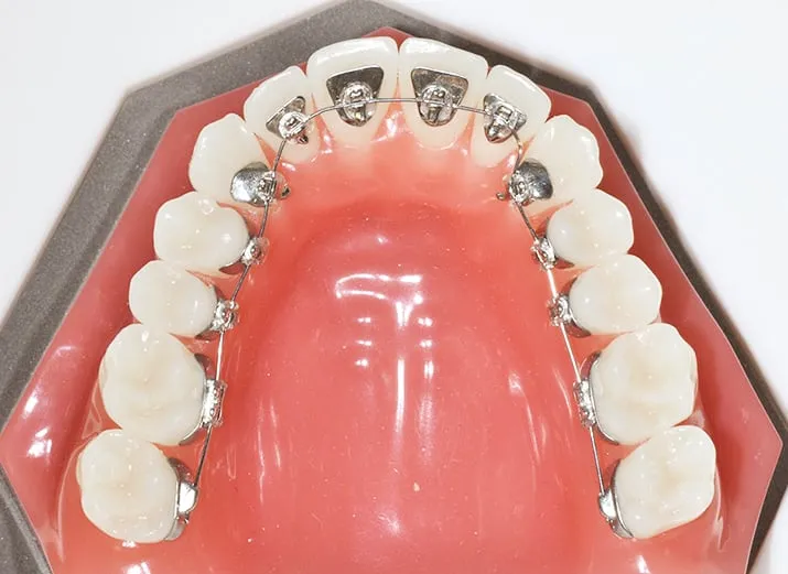 Niềng răng mặt trong giúp giấu các thành phần niềng vào bên trong cung hàm, tạo hiệu quả thẩm mỹ vượt trội