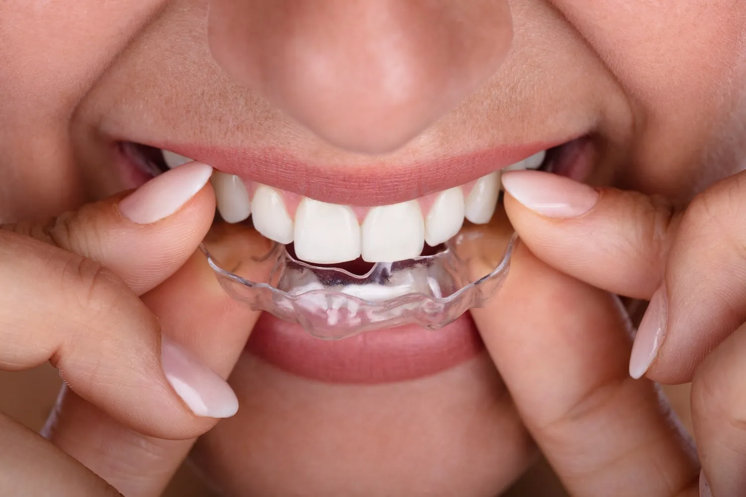 Niềng răng trong suốt Invisalign hiện đang là một trong những phương pháp niềng răng hiện đại nhất
