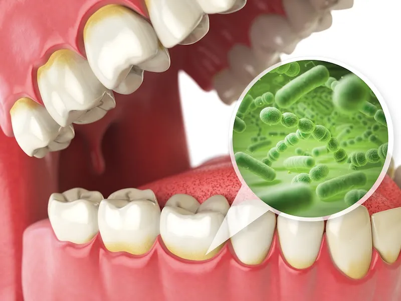 Nước súc miệng chứa Fluoride tái khoáng men răng, hạn chế vi khuẩn xâm nhập