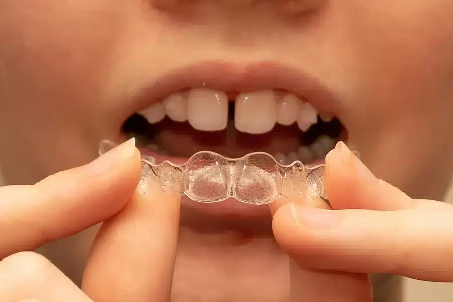 Phương pháp niềng răng trong suốt cho trẻ em