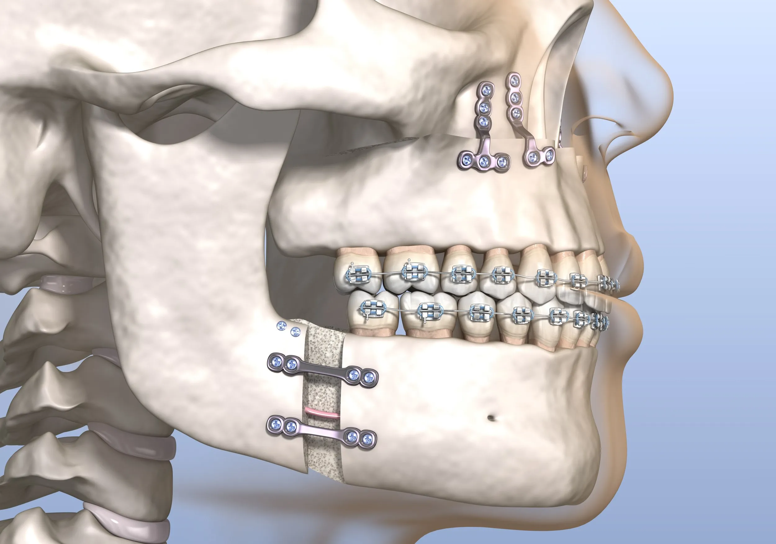Phương pháp phẫu thuật kết hợp niềng răng