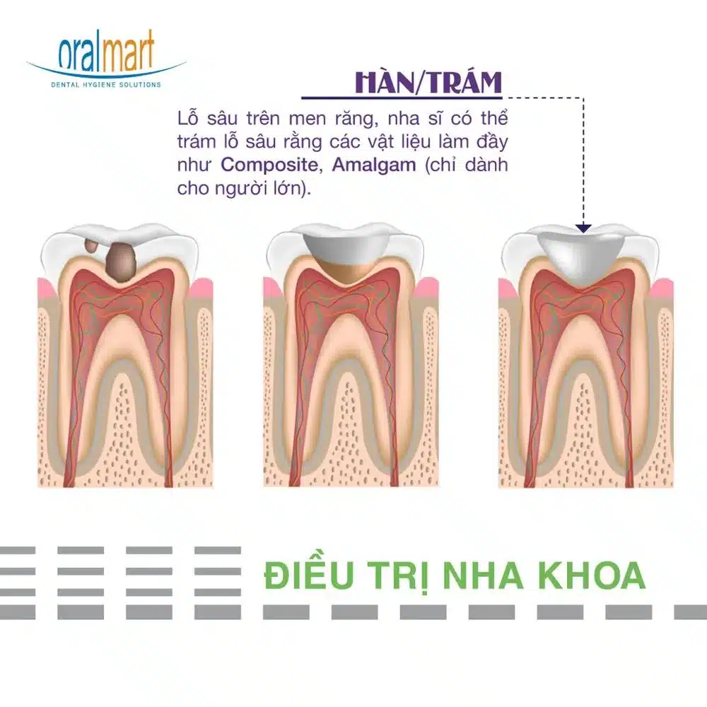 Sử dụng phương pháp trám răng điều trị sâu răng