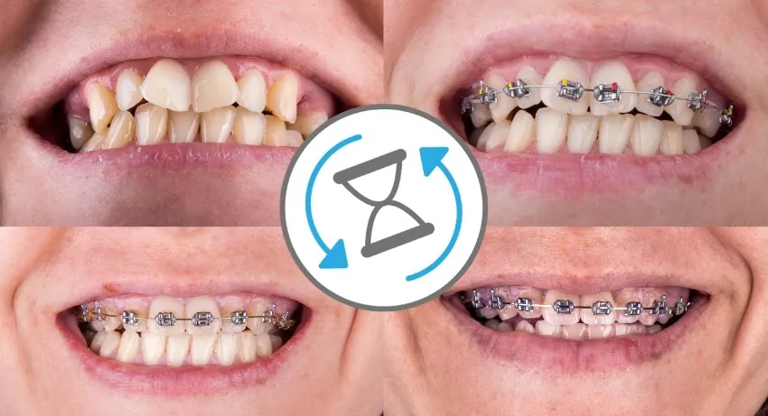 Quy trình niềng răng diễn ra như thế nào?