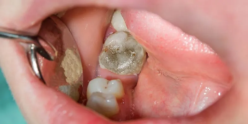 Răng chết tủy thường tạm dùng được trong một năm đầu
