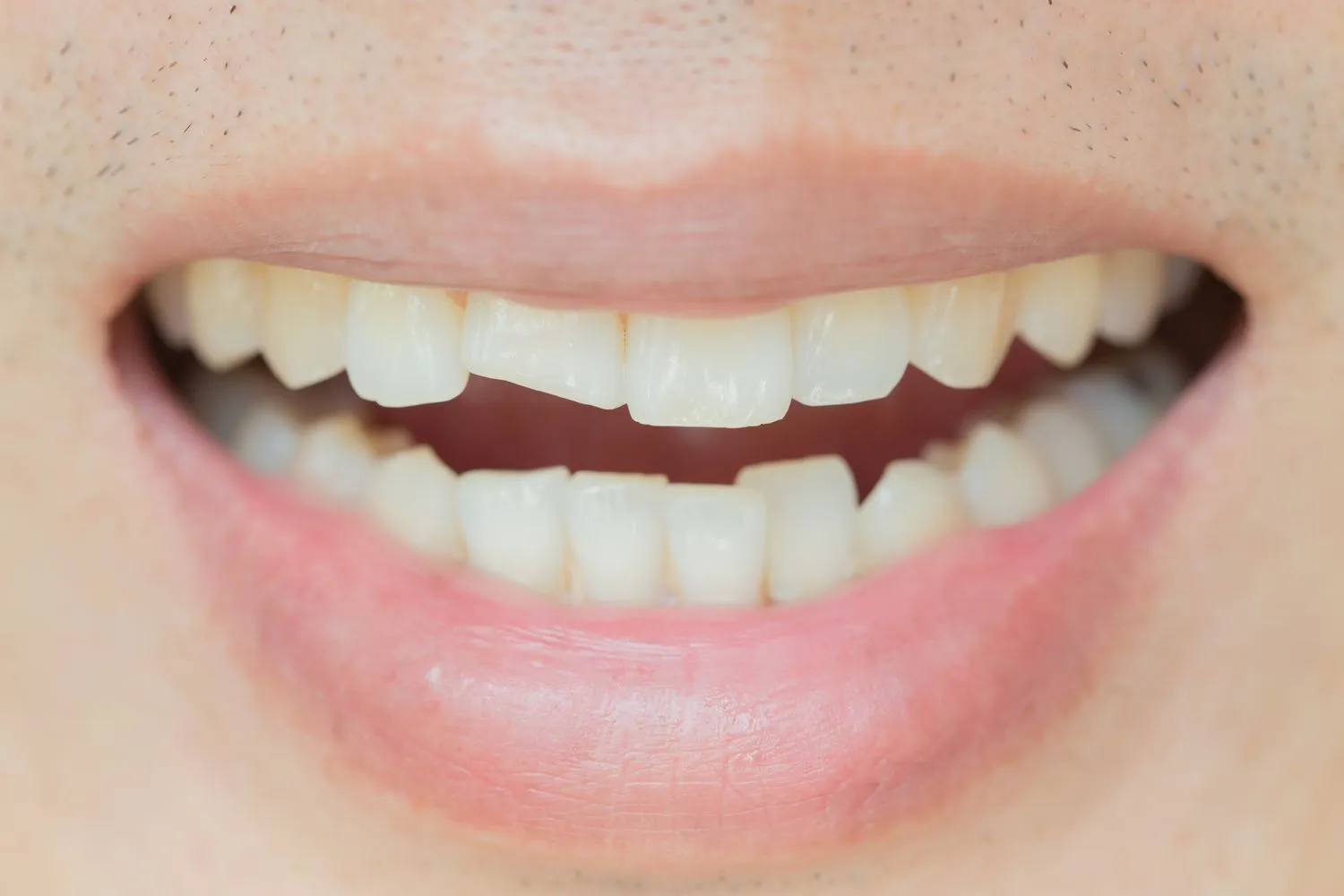 Răng bị mẻ là như thế nào?