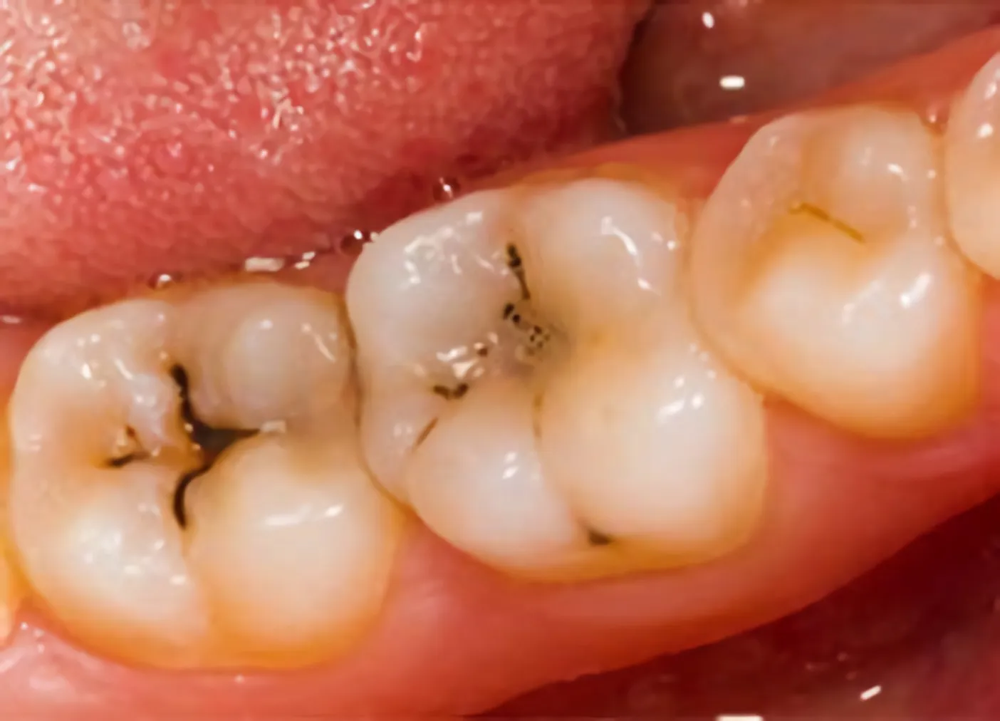 Men răng vàng tiềm ẩn nguy cơ bệnh lý