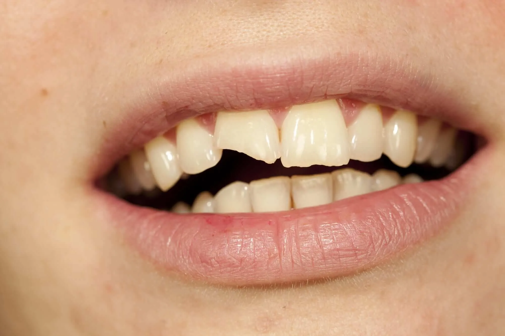 Răng bị vỡ giảm khả năng chống sâu răng