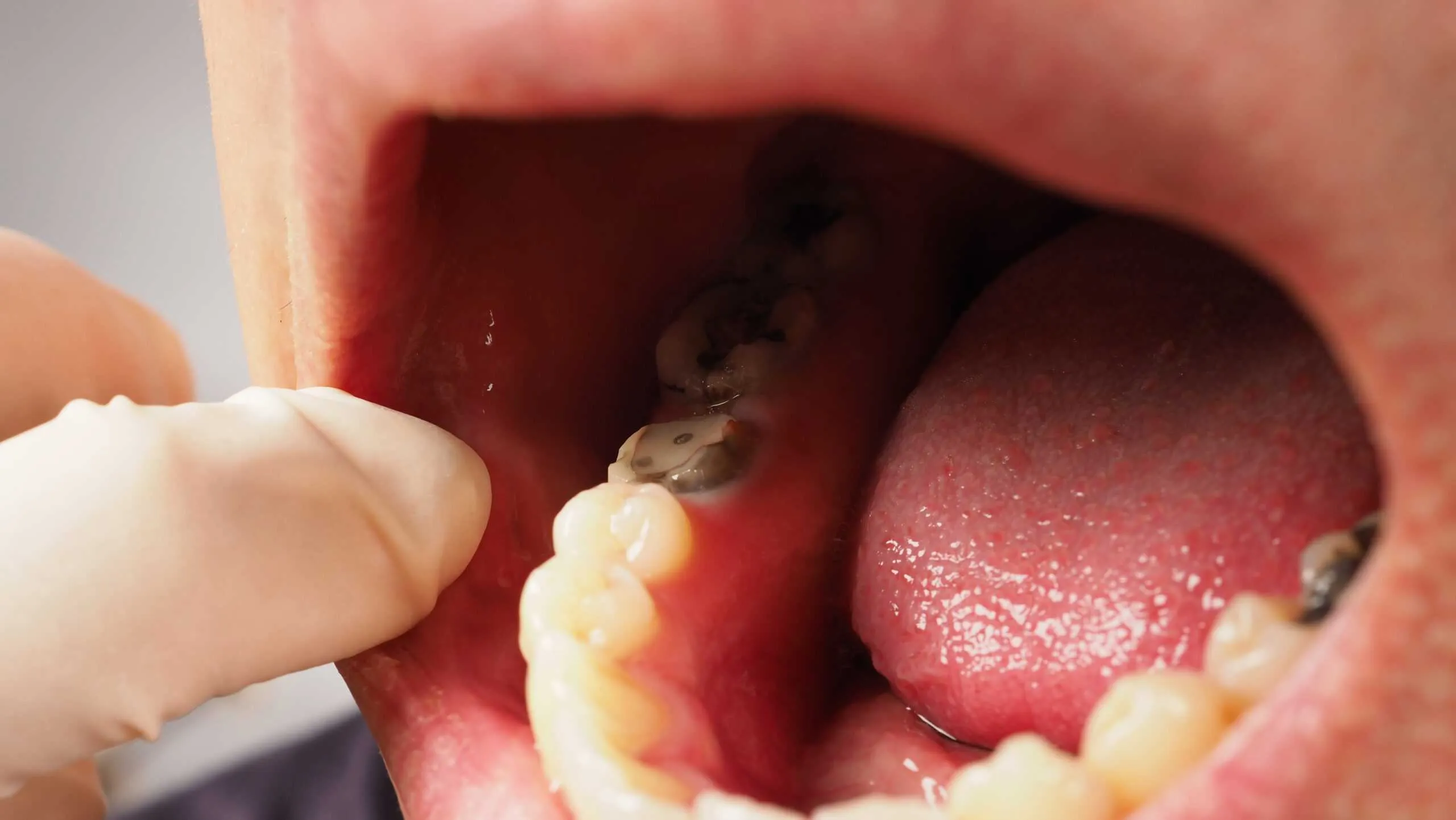 Răng cấm tiếp xúc nhiều với thức ăn nên dễ bị sâu răng