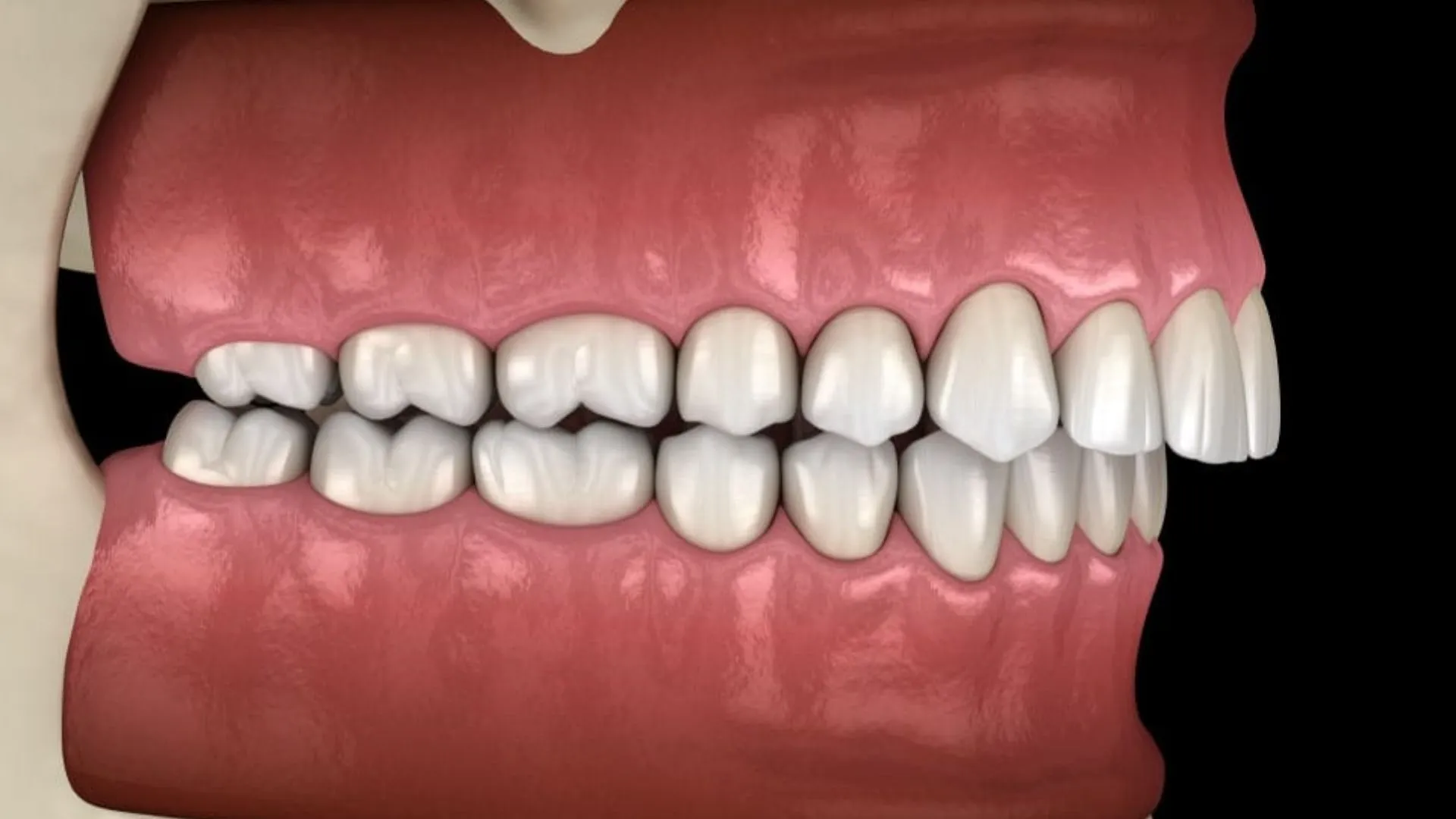 Răng hô hàm trên