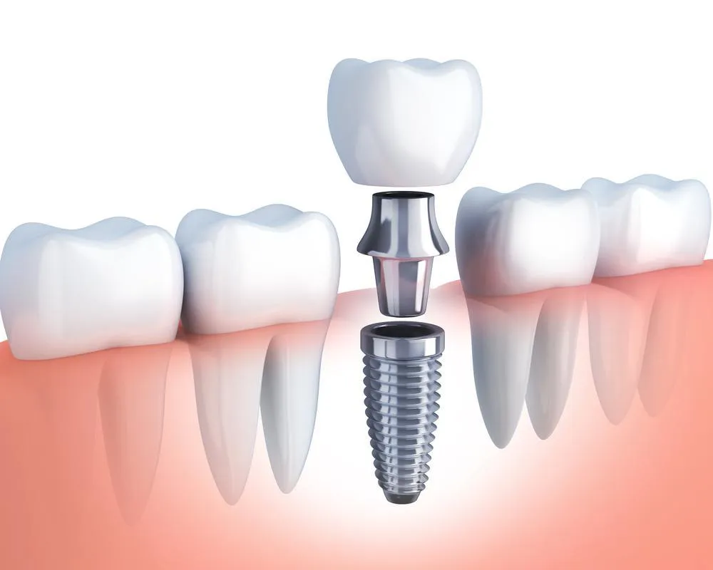 Phương pháp trồng răng implant sẽ được áp dụng khi chân răng thật đã bị lung lay do sự tấn công của vi khuẩn