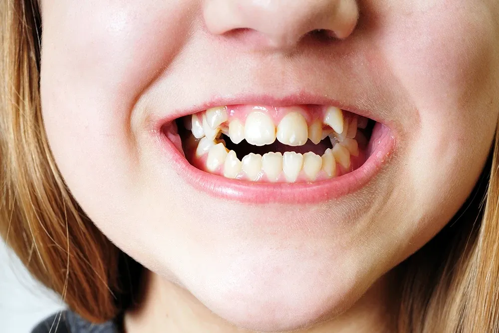 Có bao nhiêu phương pháp niềng răng khểnh? 