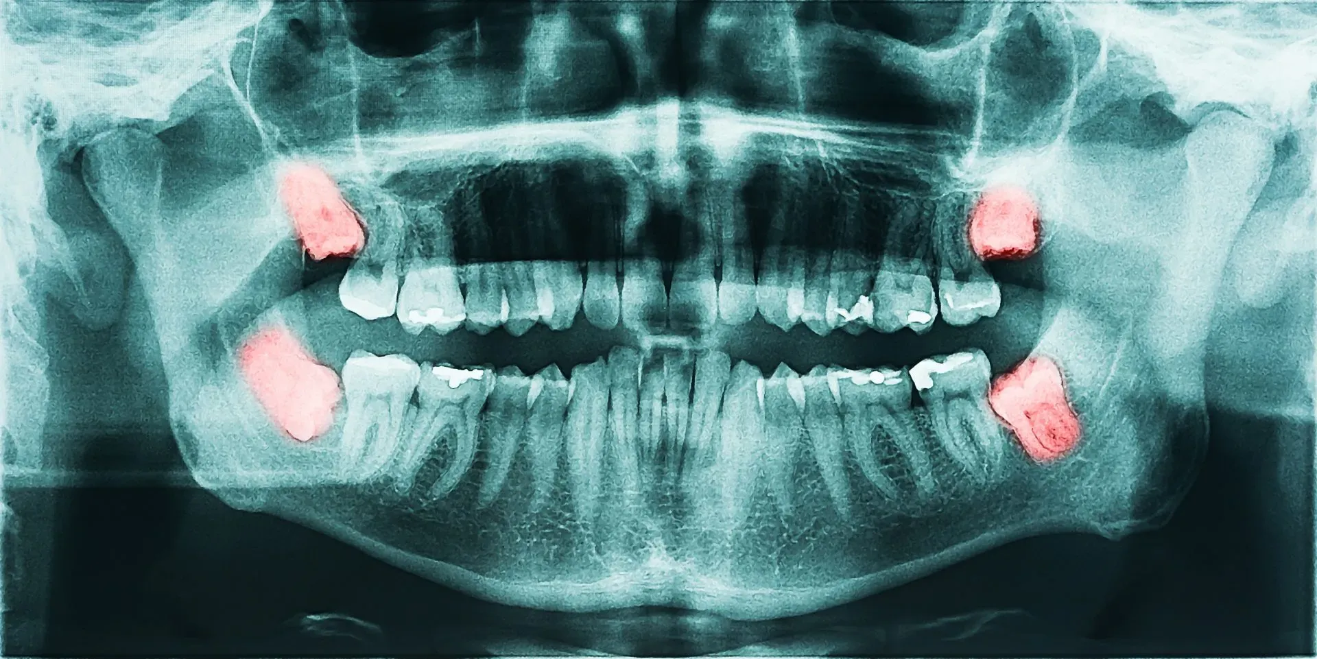 Răng khôn mọc lệch tạo khe hở nhỏ với răng bên cạnh, dễ mắc vướng thức ăn