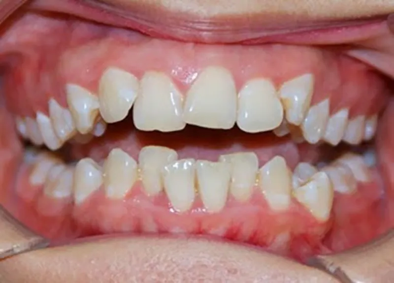 Răng cửa bị sâu do cấu trúc răng mọc lệch lạc