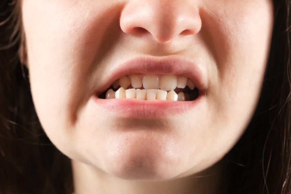 Móm răng có thể do xương hàm trên phát triển kém hoặc xương hàm bên dưới phát triển quá mức