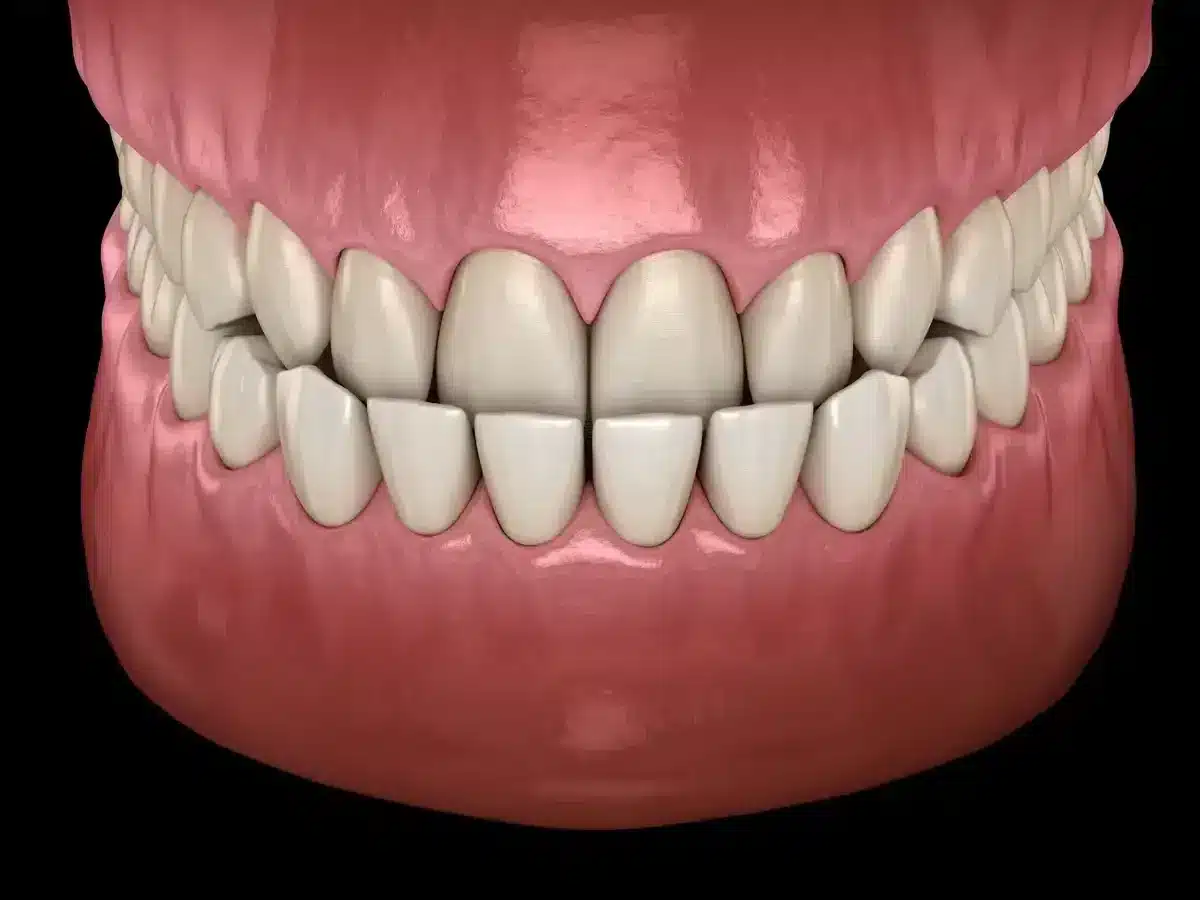 Răng móm có thể do dây chằng khớp của thái dương hàm bị lỏng lẻo sẽ khiến cho hàm dưới trượt ra phía trước