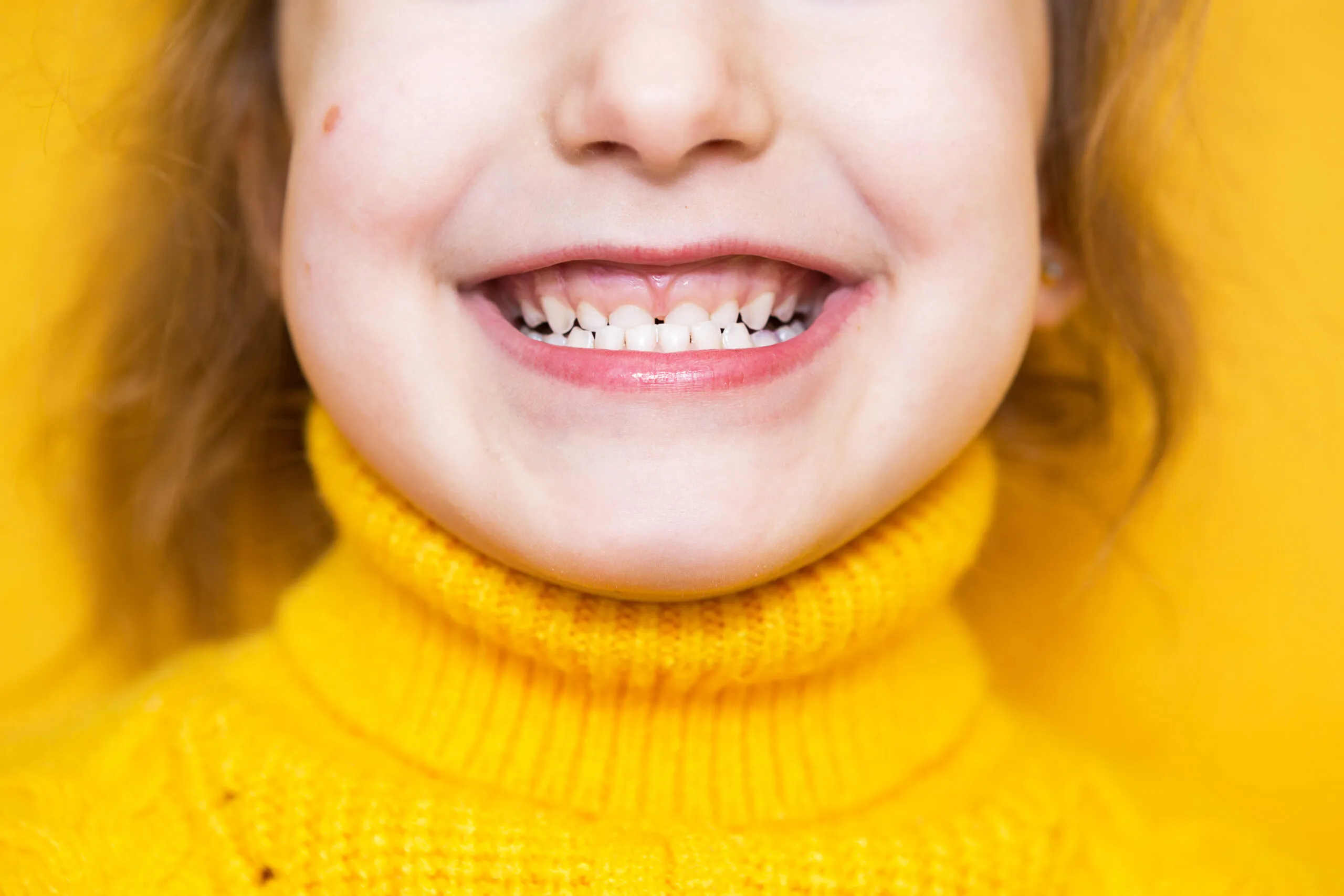 Móm răng cũng có thể xuất phát từ nguyên nhân do xương hàm phát triển quá mức