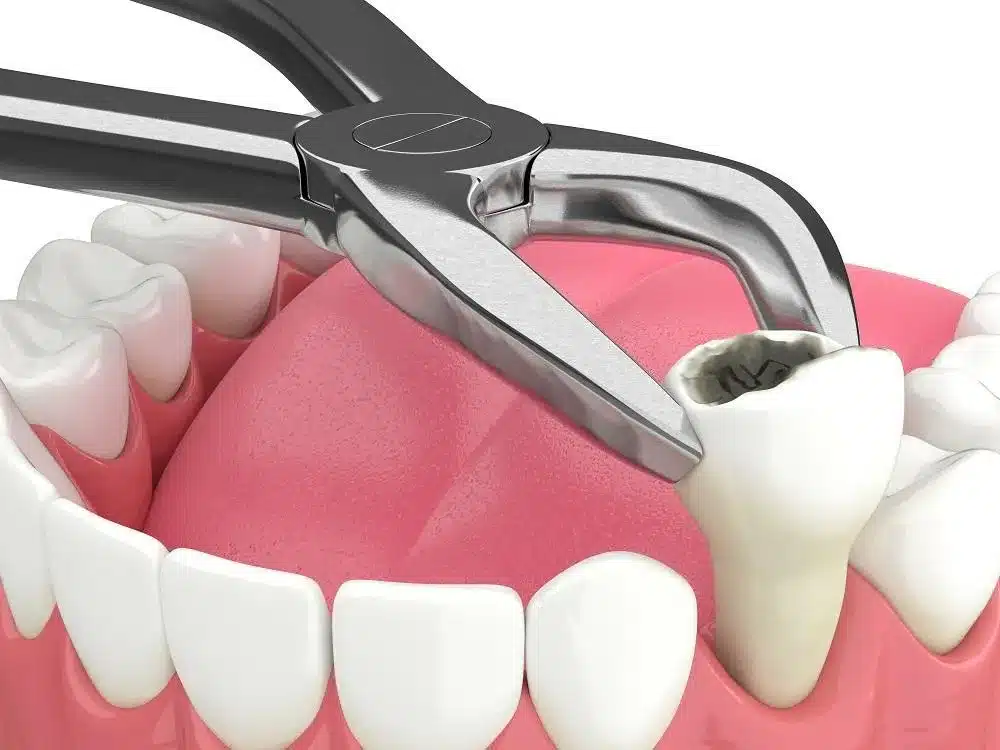 Răng sâu bị vỡ có nên nhổ không?