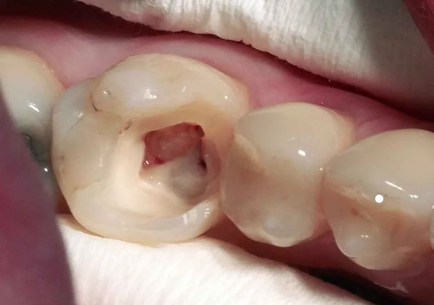 Sâu răng lồi thịt là một dạng áp xe răng