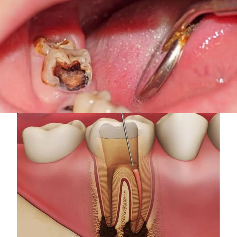 Răng sâu nặng cần lấy tủy