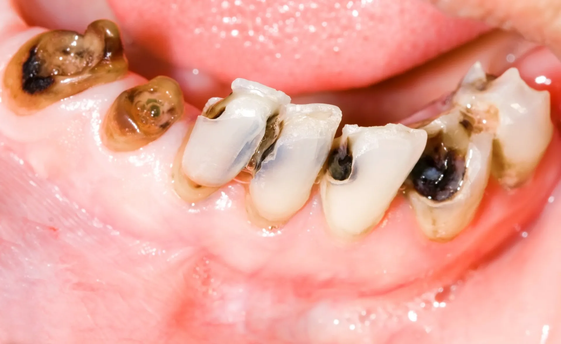 Khi bị sâu răng cần được điều trị bằng kỹ thuật hàn răng