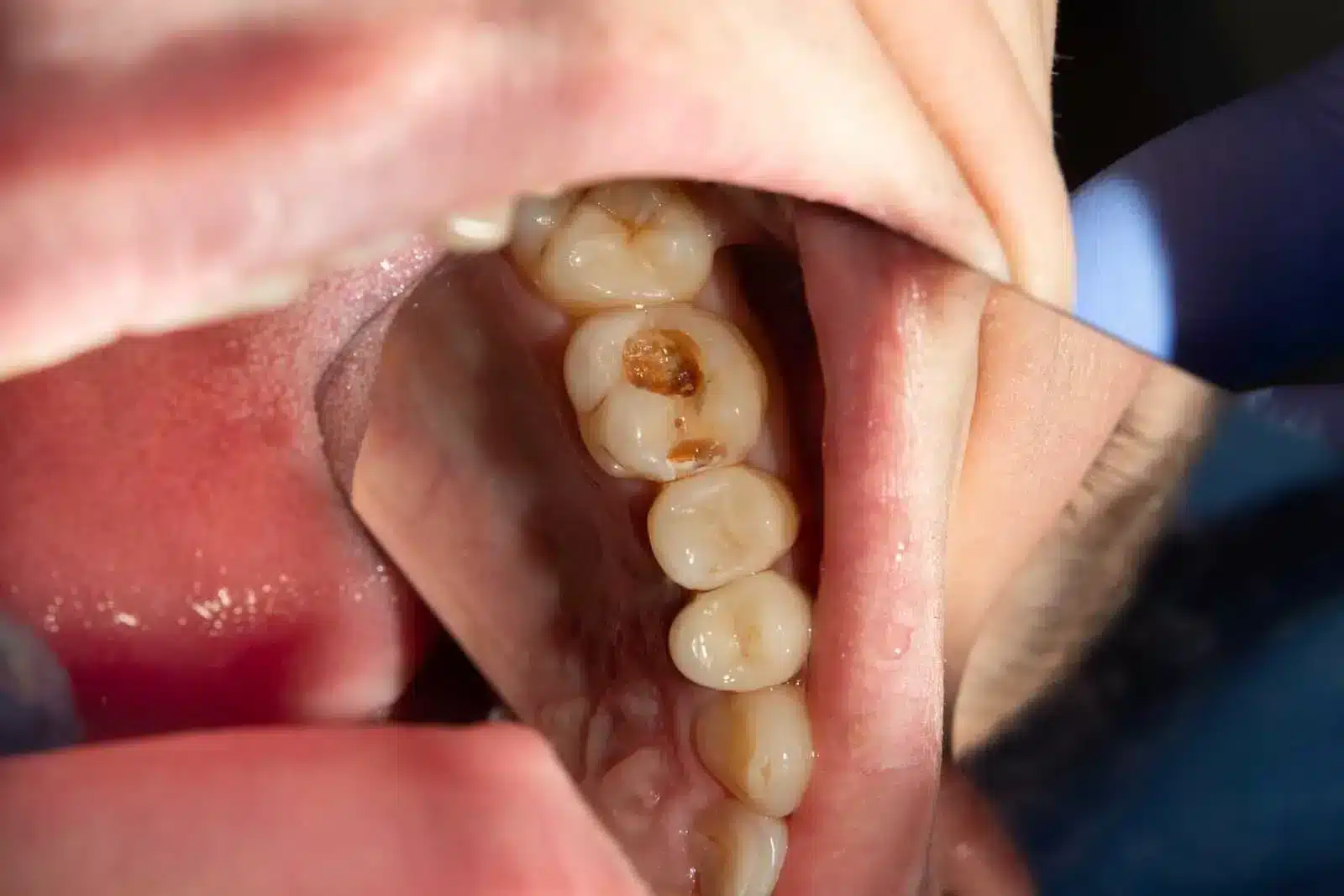 Biến chứng của răng số 7 bị sâu vỡ là gì?