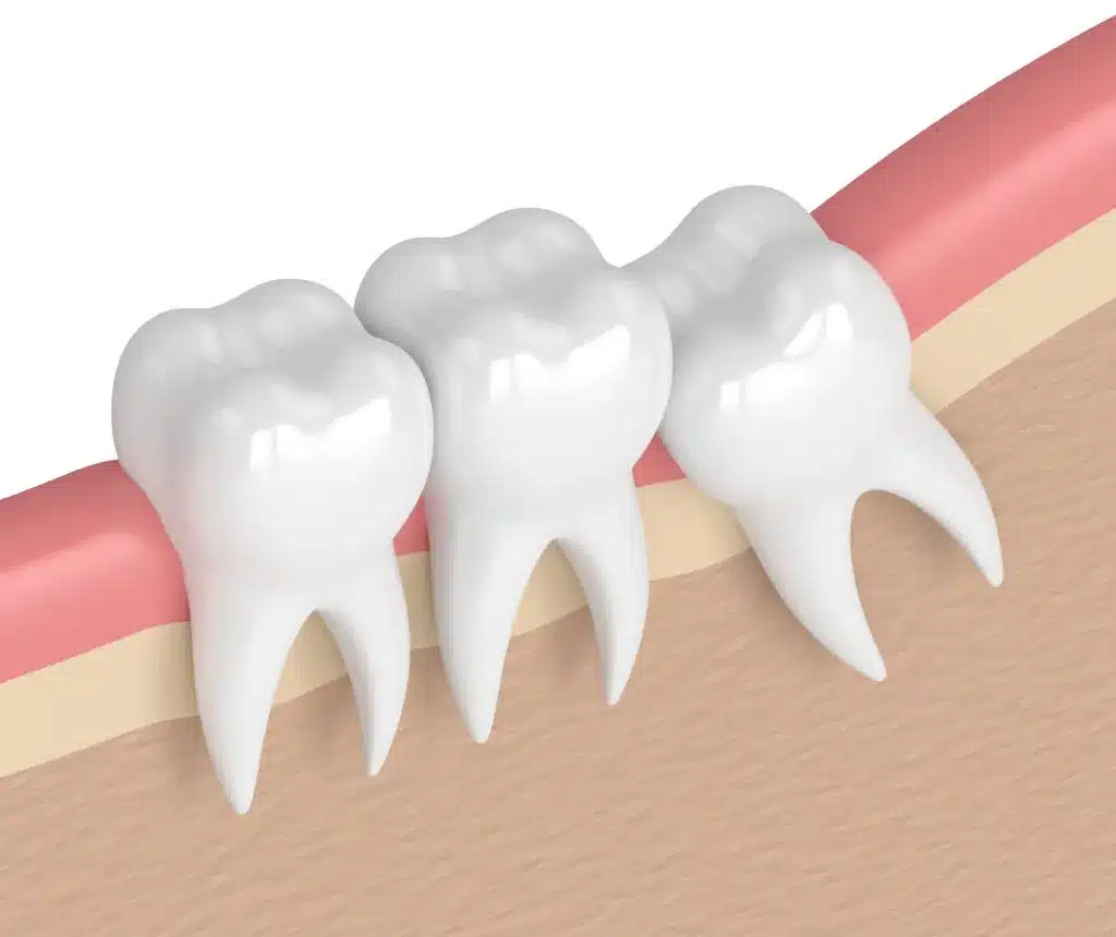 Răng số 8 có thể gây ra tổn thương cho răng số 7