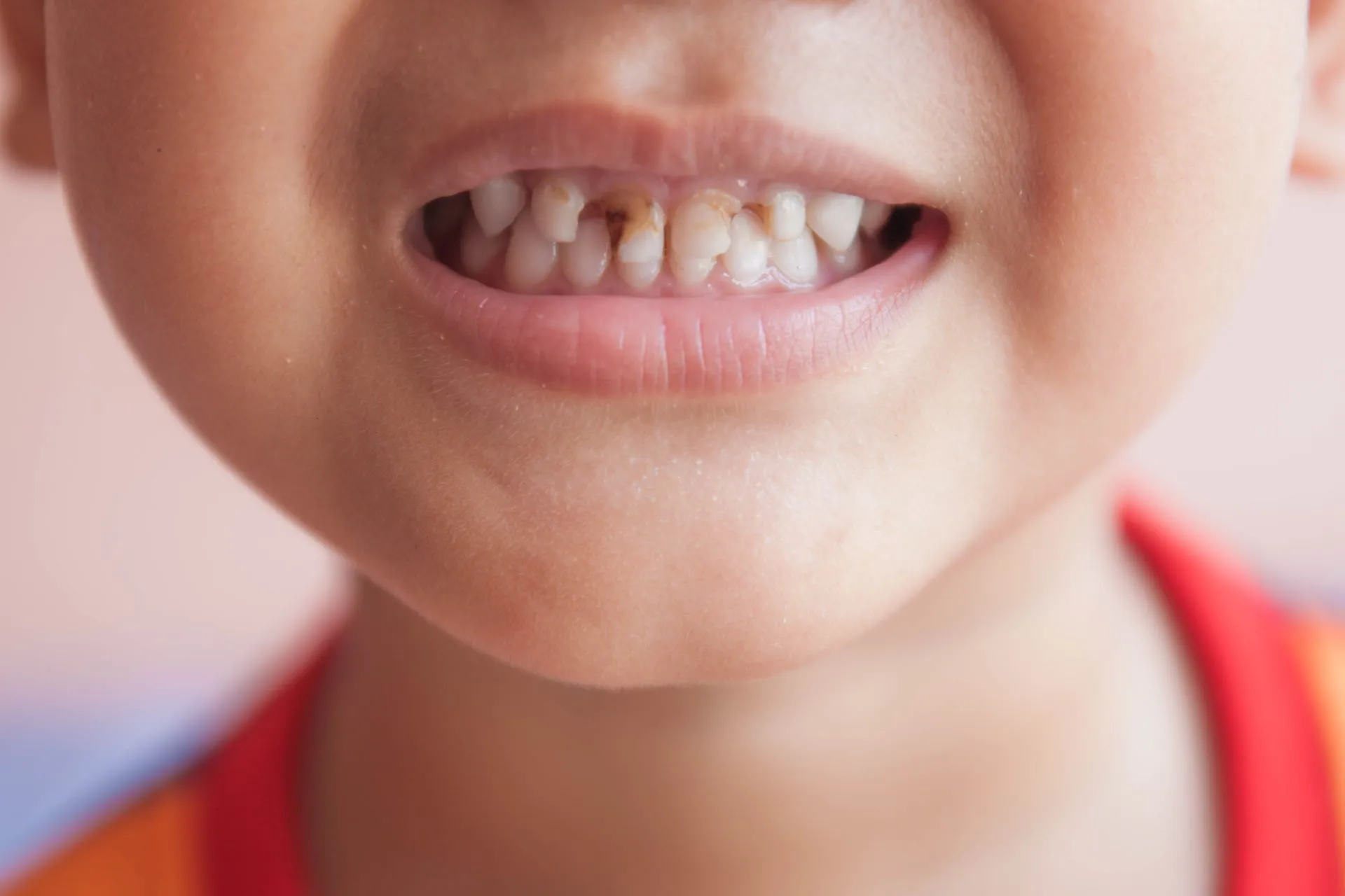 80% Trẻ em từ 6-8 tuổi bị sâu răng sữa