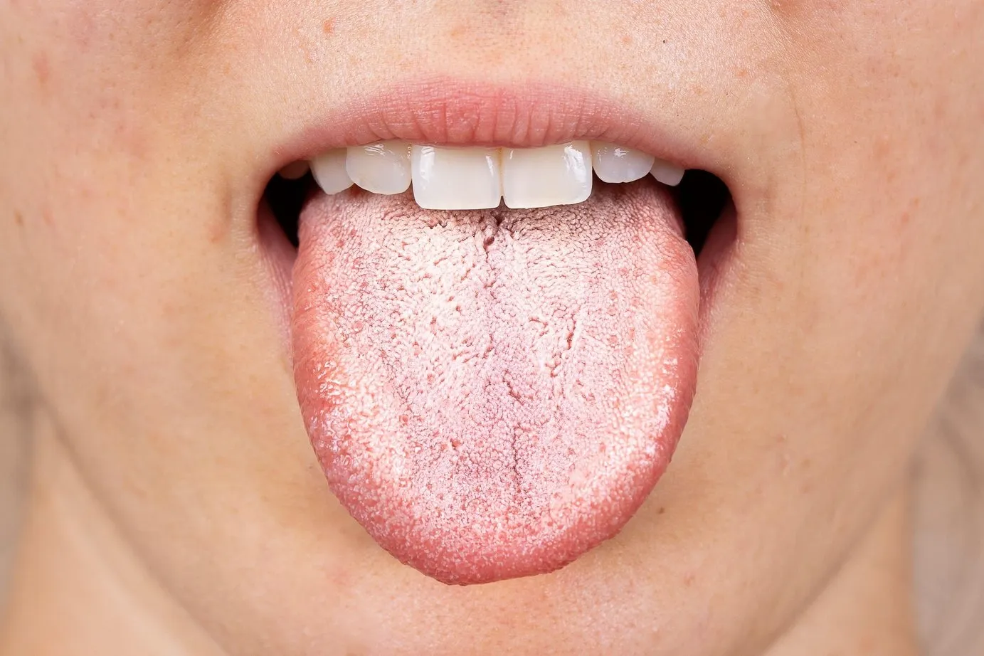 Nhiễm nấm Candida khiến lưỡi đau rát