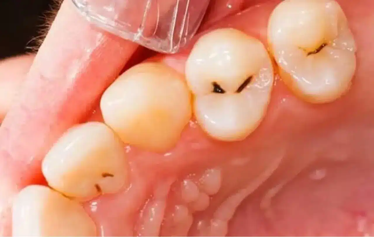 Sâu men răng