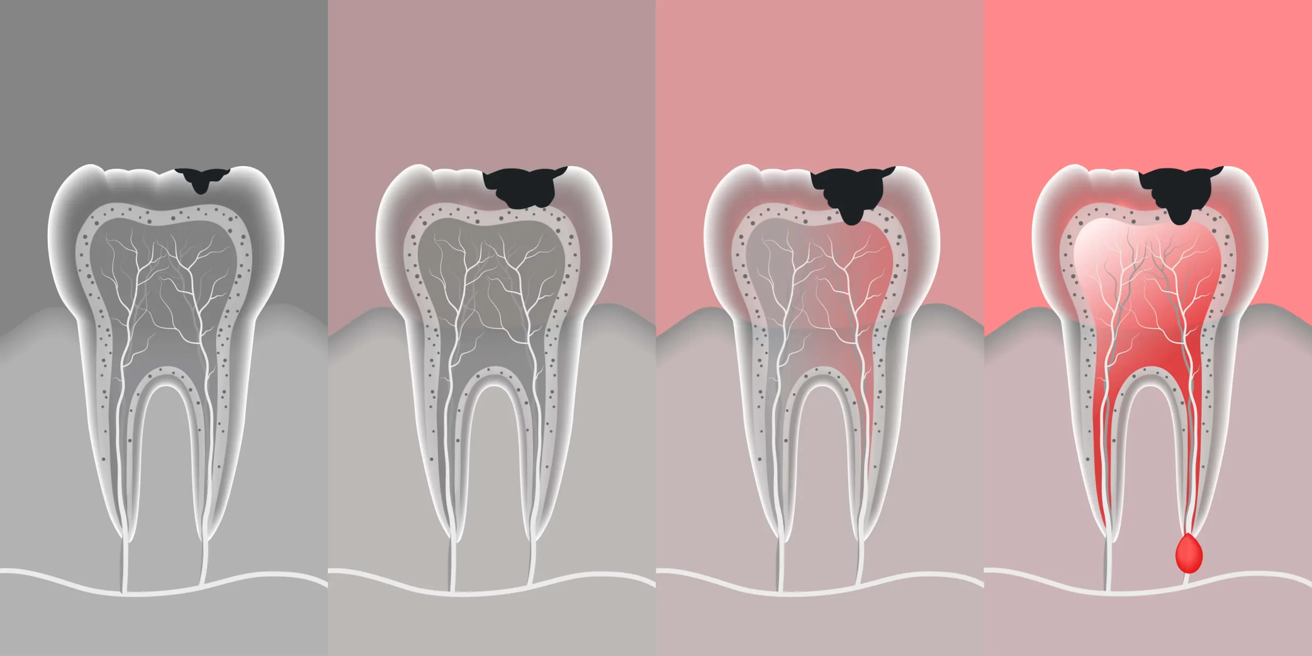 Sâu răng là tình trạng tổn thương mất mô cứng của răng, xuất phát từ men răng đến tủy răng