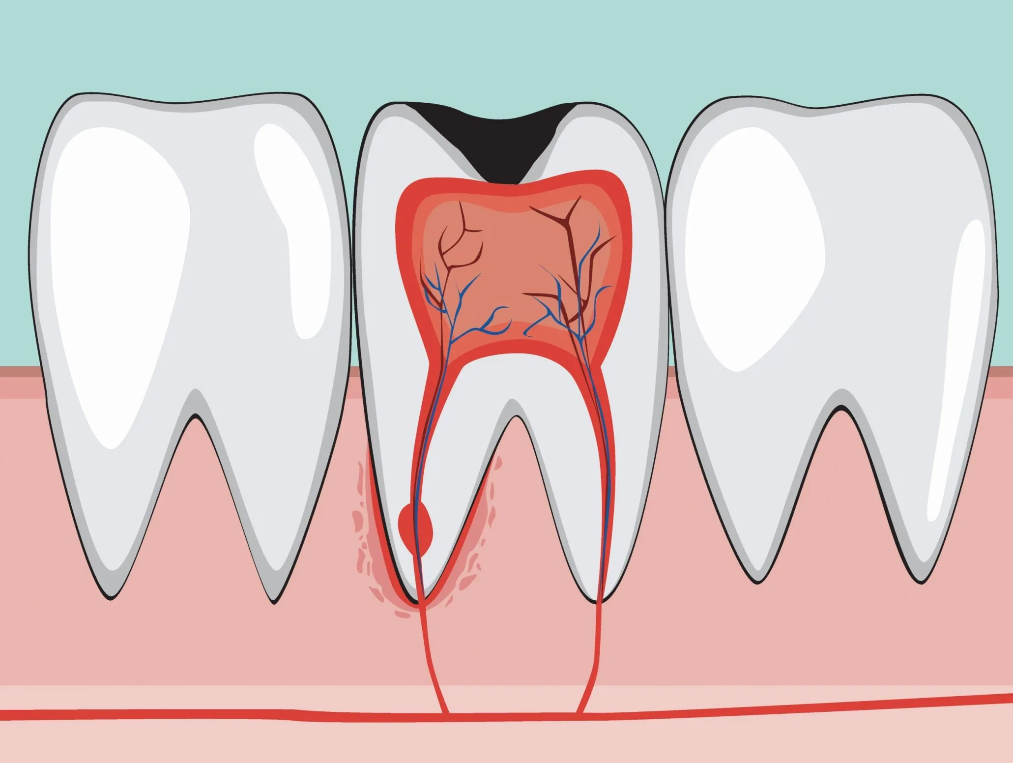 Sâu răng gây ra phản ứng viêm của tủy răng