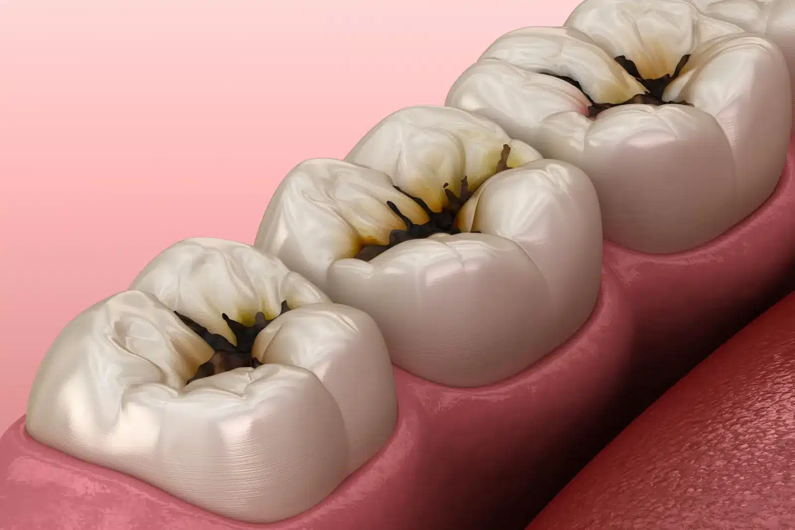 Sâu răng gây ra tổn thương trên bề mặt răng
