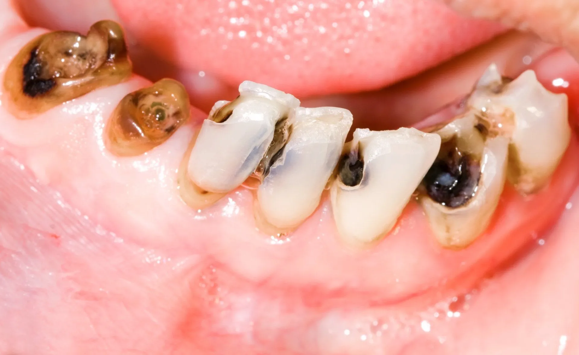 Sâu răng dễ khiến hơi thở có mùi hôi thối