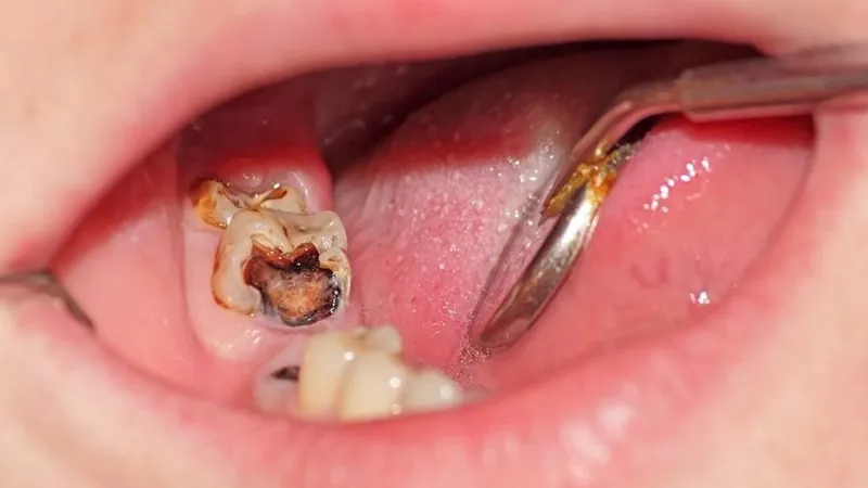 Sâu răng khôn gây ảnh hưởng răng bên cạnh và biến chứng răng miệng