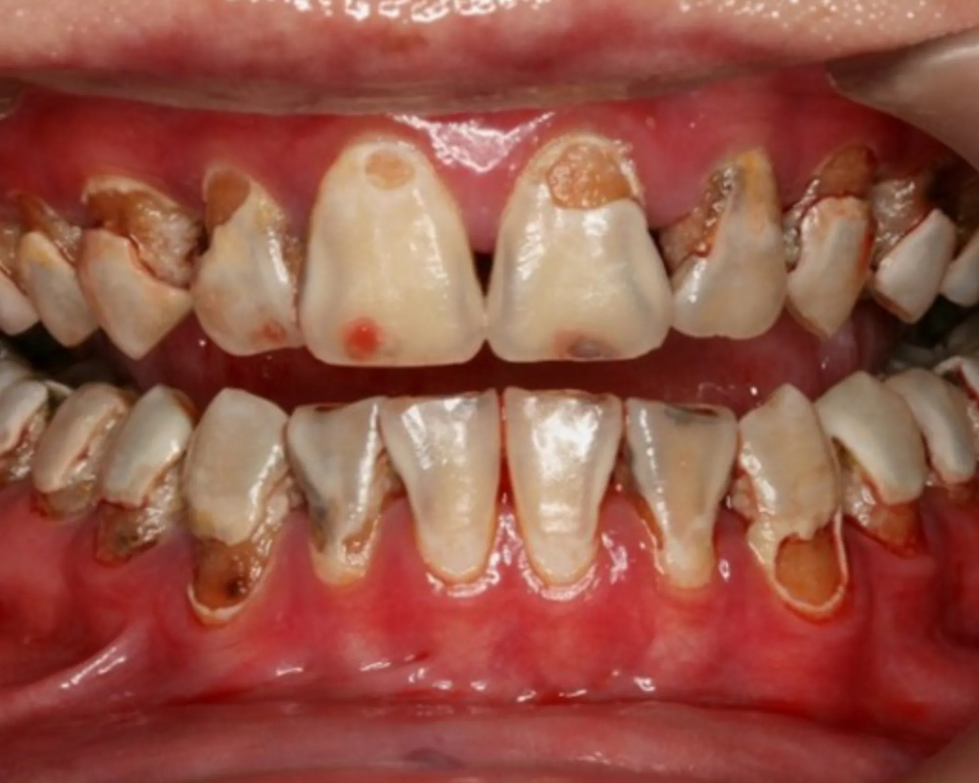 Sâu răng tiến triển nặng khi ở giai đoạn 3 