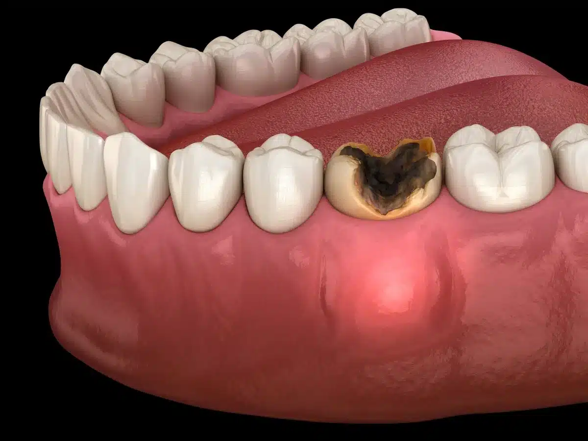 Răng sâu nặng dẫn đến áp xe răng