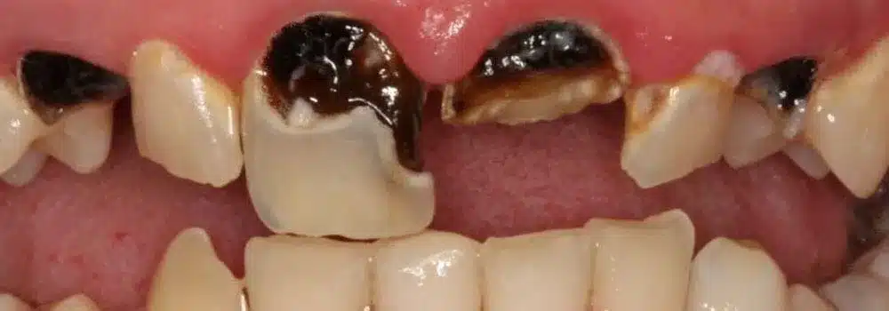 Răng bị sâu nặng làm tăng nguy cơ bị mất răng