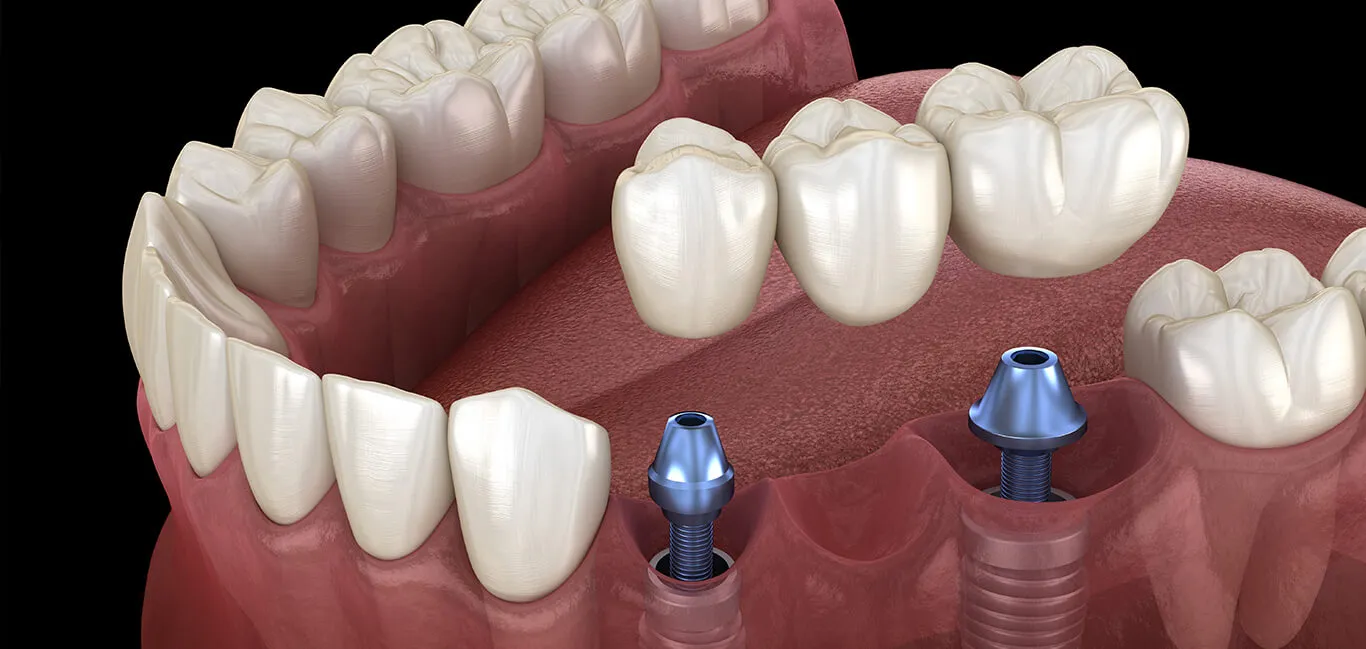 Sử dụng cầu răng sứ trên implant