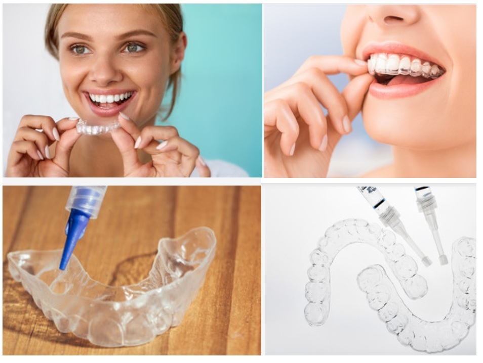 Tẩy trắng răng bằng máng là một phương pháp làm trắng răng phổ biến hiện nay 