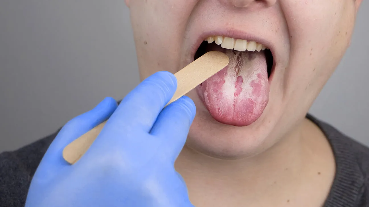 Thăm khám, xét nghiệm tìm ra nguyên nhân gây nấm lưỡi