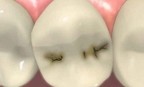 Tìm hiểu các mức độ của bệnh sâu răng